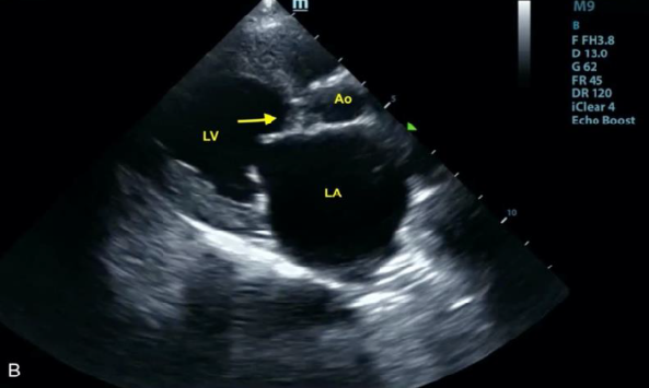 heart ultrasound screenshot