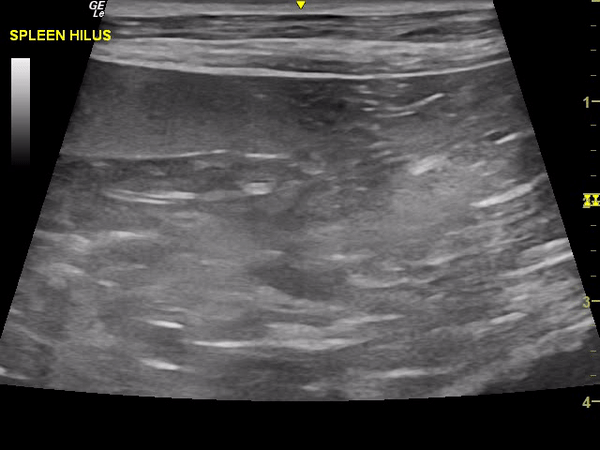 Abdominal Ultrasound GIF