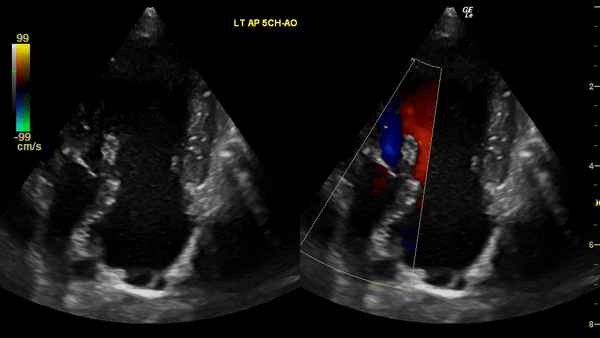 Cardiac Ultrasound GIF