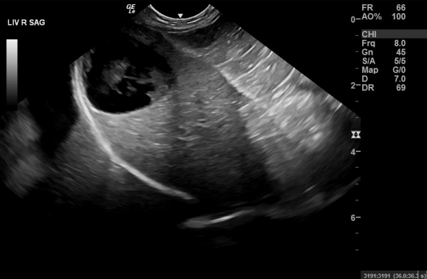 Abdominal Ultrasound